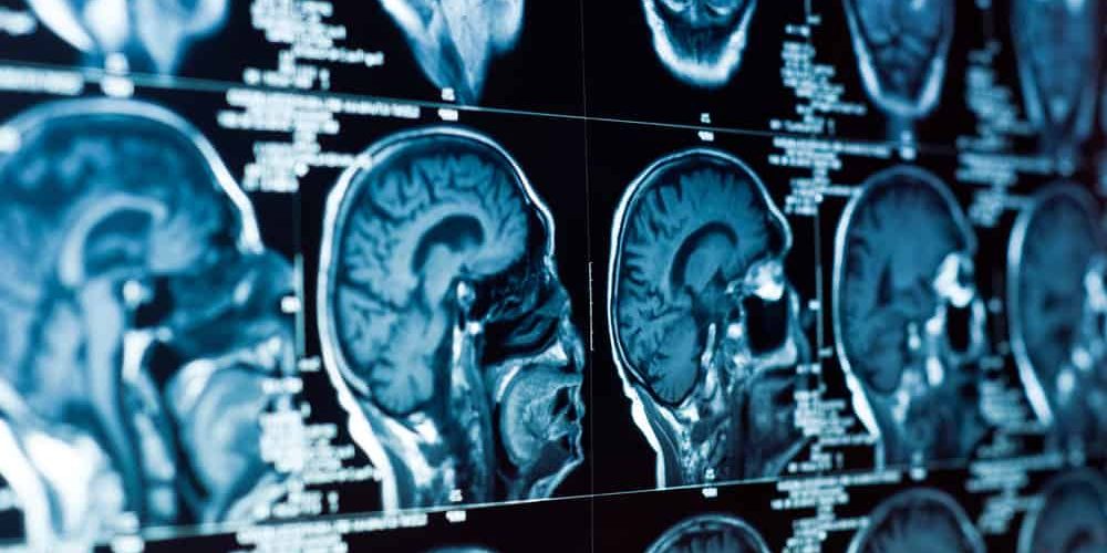 Brain Injury Treatment and Rehab